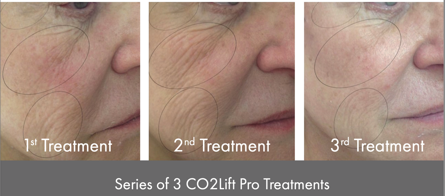 CO2 Lift Carboxy Gel Treatment - 3-Pack